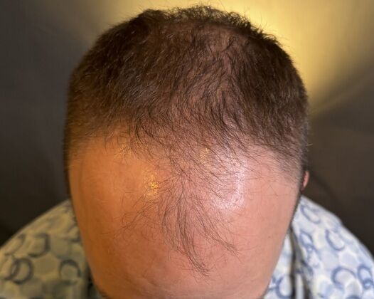 FUE Hair Restoration: Case 38 - Before