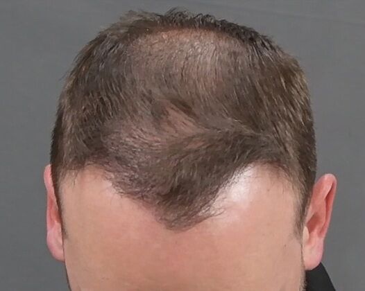 FUE Hair Restoration: Case 38 - After