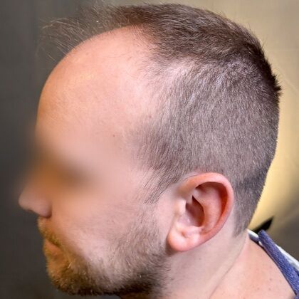 FUE Hair Restoration: Case 38 - Before