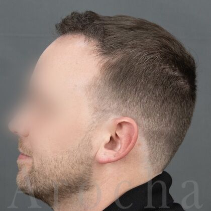 FUE Hair Restoration: Case 38 - After