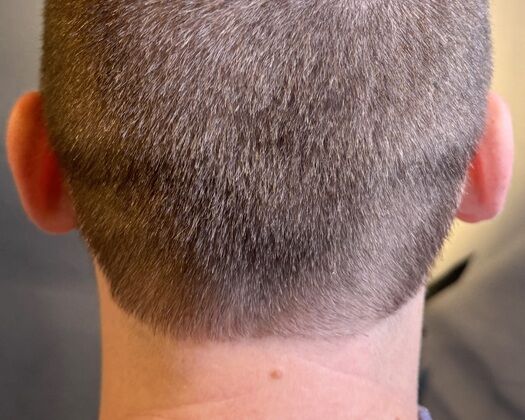 FUE Hair Restoration: Case 38 - Before