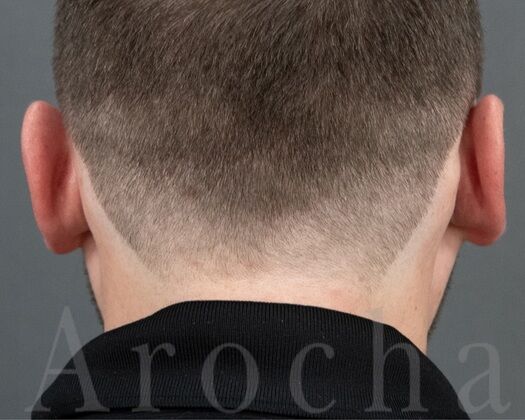 FUE Hair Restoration: Case 38 - After