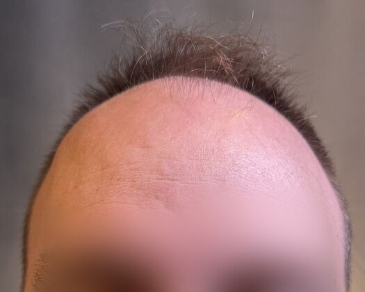 FUE Hair Restoration: Case 38 - After