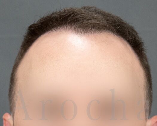 FUE Hair Restoration: Case 38 - Before