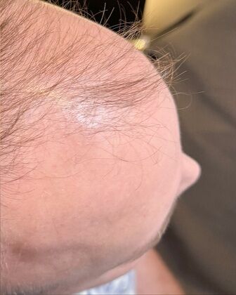 FUE Hair Restoration: Case 38 - Before