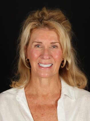 Dental Implants Sheri - After