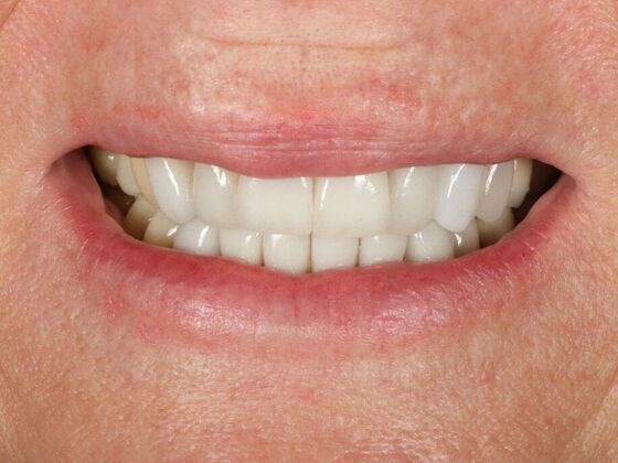 Dental Implants: Sheri - Before