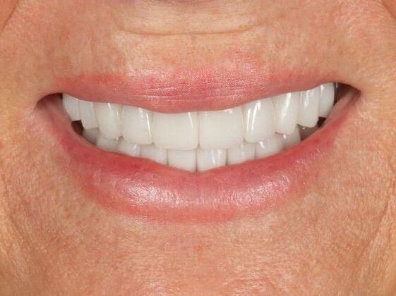 Dental Implants: Sheri - After