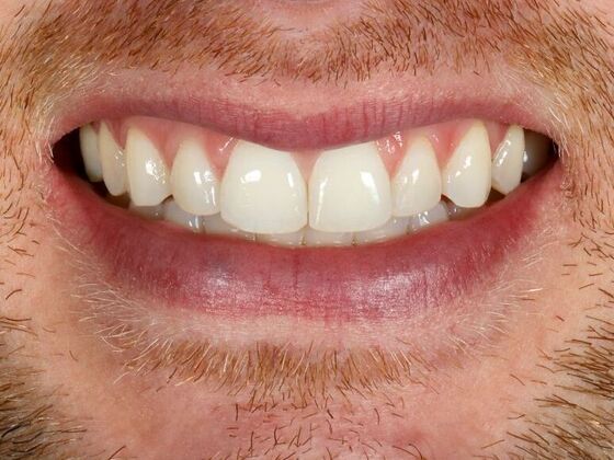 Porcelain Veneers: Blaine - Before