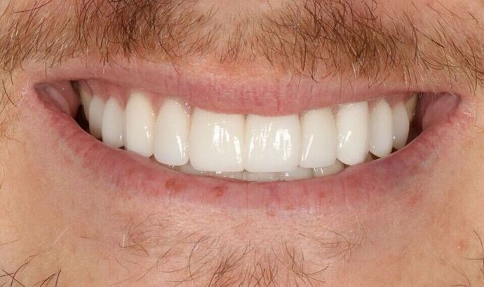 Porcelain Veneers: McKade - After