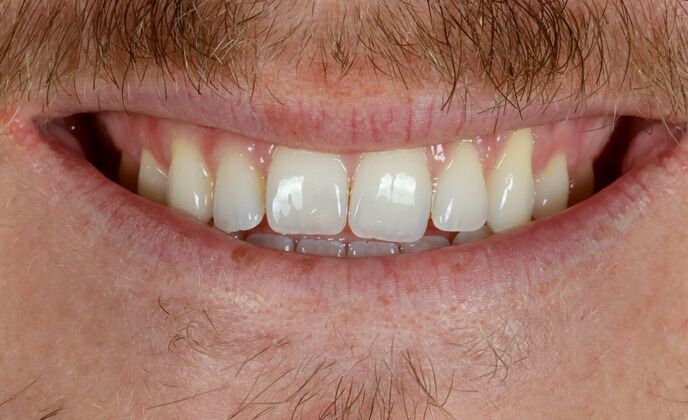 Porcelain Veneers: McKade - Before