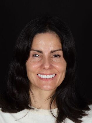 Porcelain Veneers Yeni - After