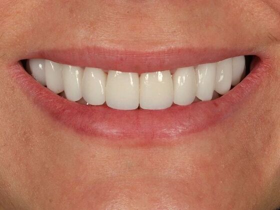 Porcelain Veneers: Yeni - After
