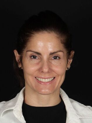 Porcelain Veneers Yeni - Before