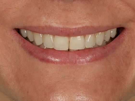 Porcelain Veneers: Yeni - Before
