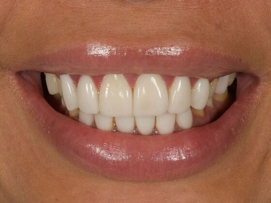 Porcelain Veneers: Angela - Before