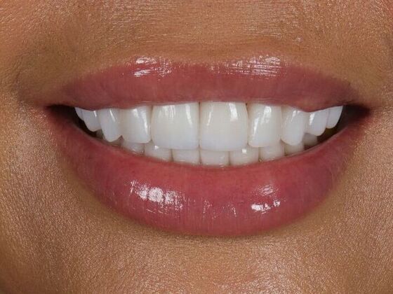 Porcelain Veneers: Angela - After