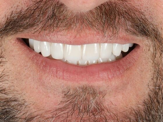 Porcelain Veneers: Doug - After