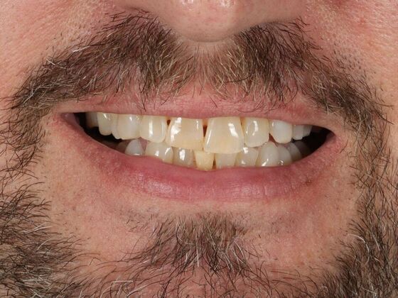 Porcelain Veneers: Doug - Before