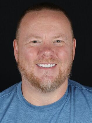 Porcelain Veneers Jeff - After