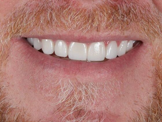 Porcelain Veneers: Jeff - After