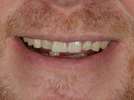 Porcelain Veneers: Jeff - Before