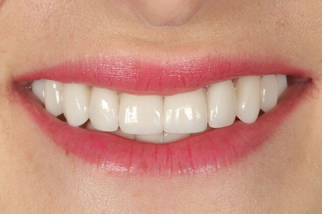 Porcelain Veneers: Katie - After