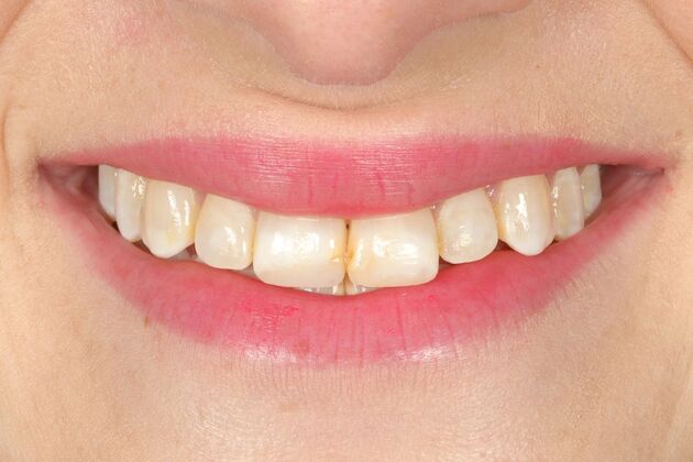 Porcelain Veneers: Katie - Before