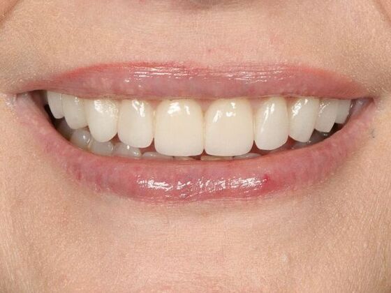 Porcelain Veneers: Melanie - After