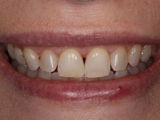 Porcelain Veneers: Melanie - Before