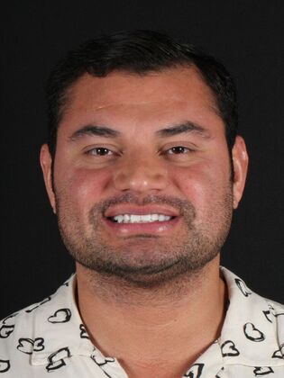 Porcelain Veneers Jose - Before