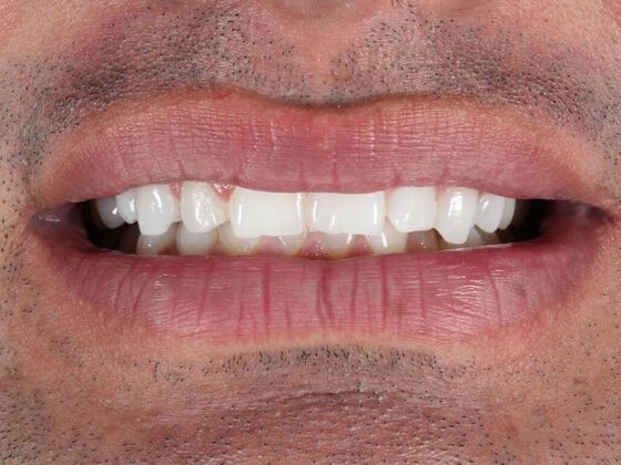 Porcelain Veneers: Jose - Before