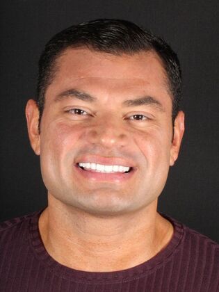 Porcelain Veneers Jose - After