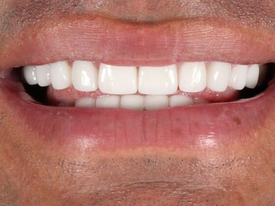 Porcelain Veneers: Jose - After