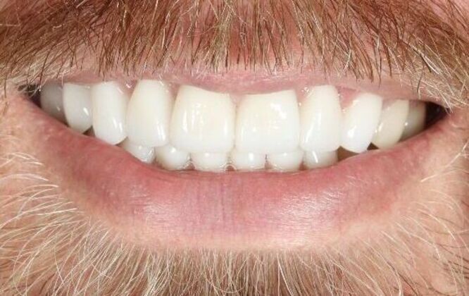 Porcelain Veneers: Craig - After