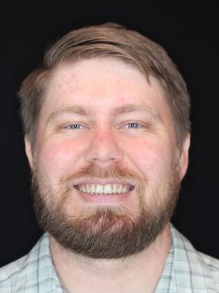 Porcelain Veneers Craig - Before