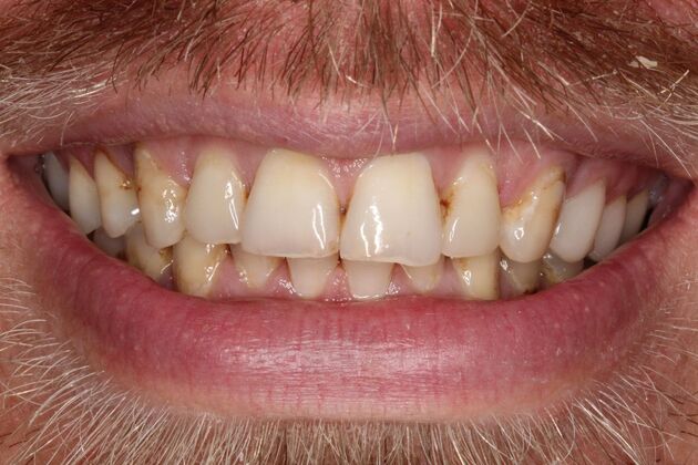 Porcelain Veneers: Craig - Before