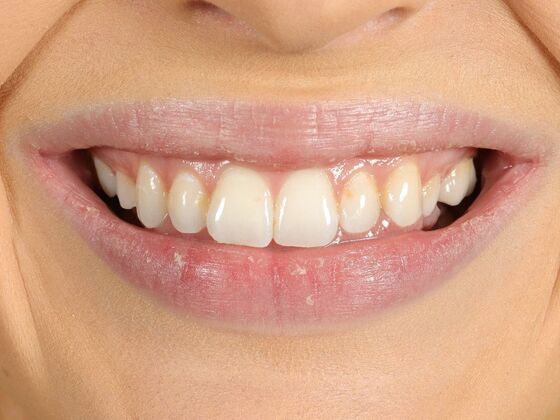 Porcelain Veneers: Casey - Before