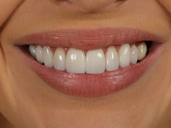 Porcelain Veneers: Casey - After