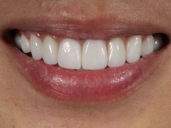 Porcelain Veneers: Cynthia - After
