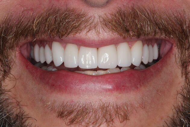 Porcelain Veneers: James - After