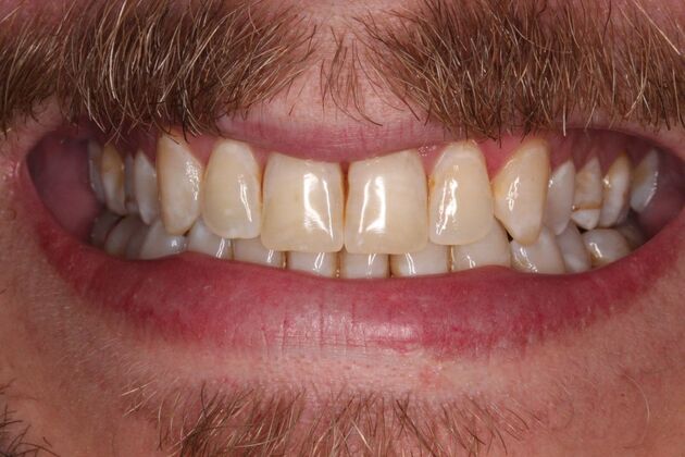 Porcelain Veneers: James - Before