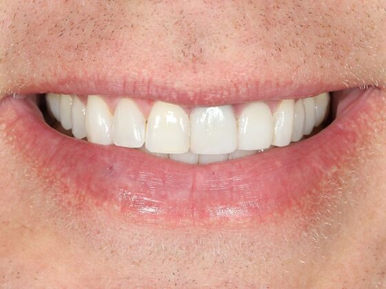 Porcelain Veneers: Bobby - Before