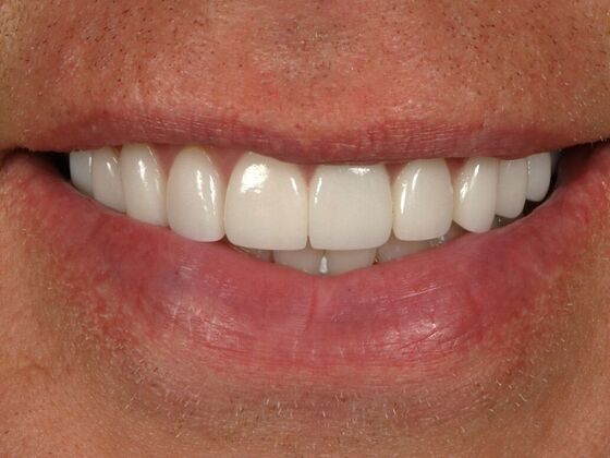 Porcelain Veneers: Bobby - After