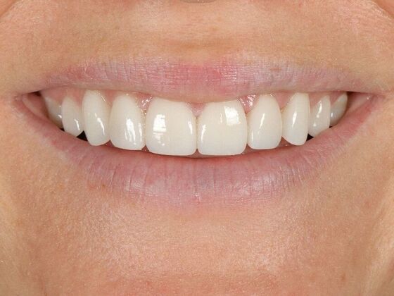 Porcelain Veneers: Jaimie - After