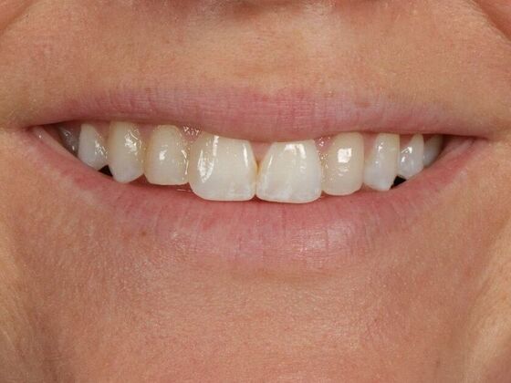 Porcelain Veneers: Jaimie - Before