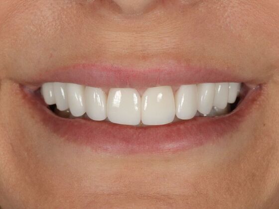 Porcelain Veneers: Maritza - After