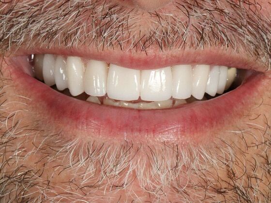 Porcelain Veneers: Paul - After