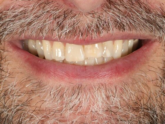 Porcelain Veneers: Paul - Before
