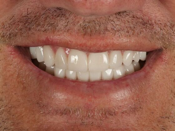 Porcelain Veneers: Walt - After
